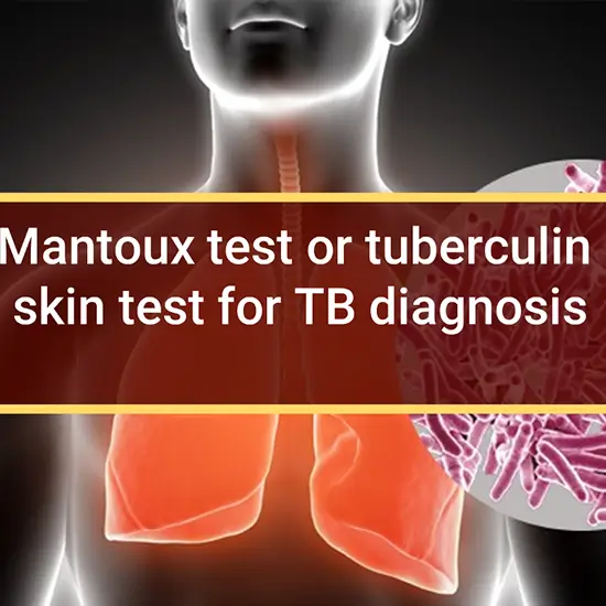 Tuberculin Skin Mantoux